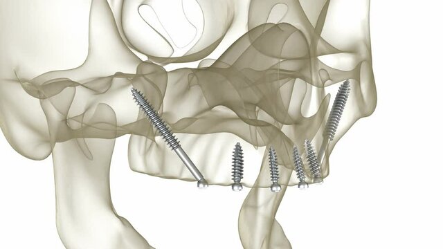Maxillary and Mandibular prosthesis supported by zygomatic implants. Medically accurate 3D animation of human teeth and dentures