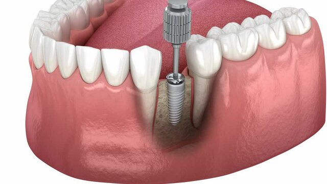 Cover screw and healing cap over implant. Medically accurate dental 3D animation