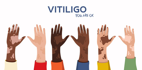 Hands of people with vitiligo are raised up and there is a place for text in the middle. Pigmentation on the hands. World Vitiligo Day concept. Banner design. Vector stock illustration.