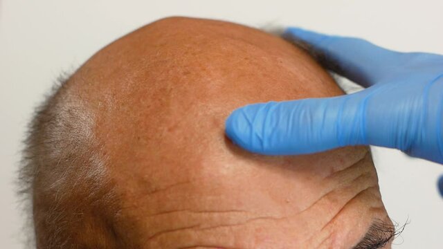 Anti-aging treatments for balding men. Close-up A trichologist in gloves examines a patient with alopecia. Hair growth clinic. The topic of hair loss in men. Selective focus