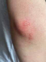 Psoriasis skin condition that causes red, flaky, crusty patches of skin covered with silvery...