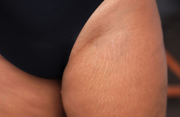 Close up of  woman skin legs  on the thigh for the presence of stretch marks and cellulite
