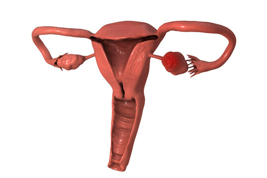 Ovarian cancer, 3D illustration