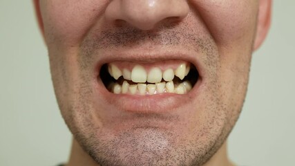 Man shows yellow, crooked and worn down teeth. Close up view on bad condition teeth. Dental disease.