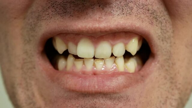 Man shows yellow, crooked and worn down teeth. Close up view on bad condition teeth. Dental disease.