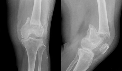 x ray of a knee broken leg