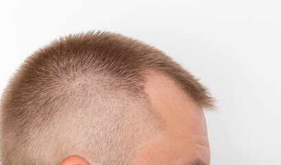 Bald patches on the head of a young man. The concept of the increased hormone dihydrotestosterone....