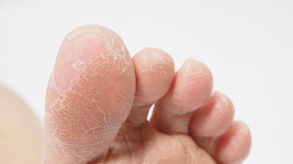 Fototapeta premium Foot peeling or remove dead skin on white background.