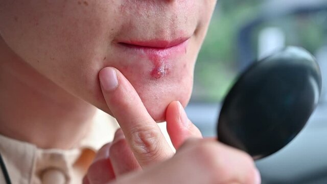 Footage of woman using mini mirror for looking Herpes labialis occur on her lower lip. Herpes simplex virus is an infection that causes herpes.