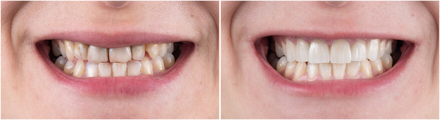 teeth treatment before and after picture - obrazy, fototapety, plakaty