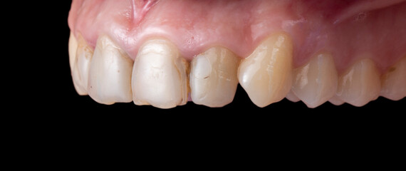natural teeth with cavities before starting dental treatment