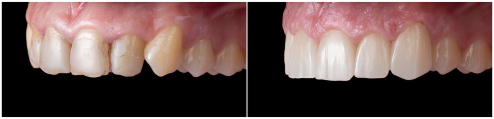 teeth treatment before and after picture