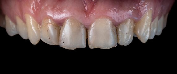 Fototapeta na wymiar natural teeth with cavities before starting dental treatment