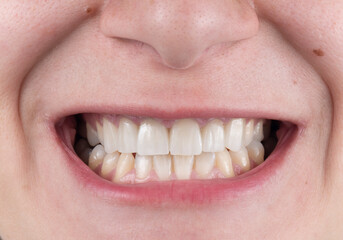 Fototapeta premium press ceramic crowns and veneers