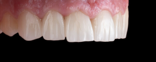 press ceramic crowns and veneers