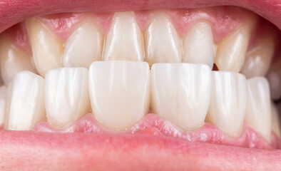 press ceramic crowns and veneers