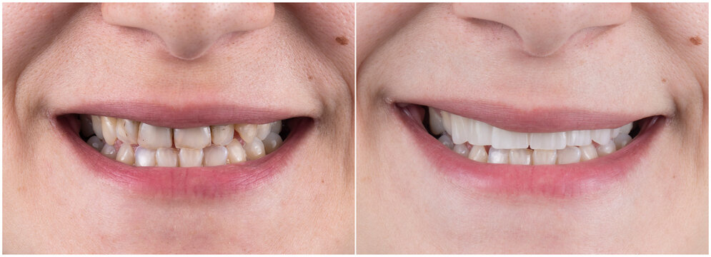 teeth treatment before and after picture