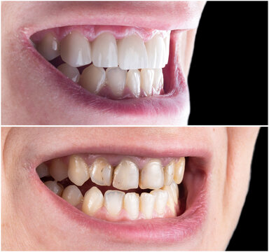 teeth treatment before and after picture