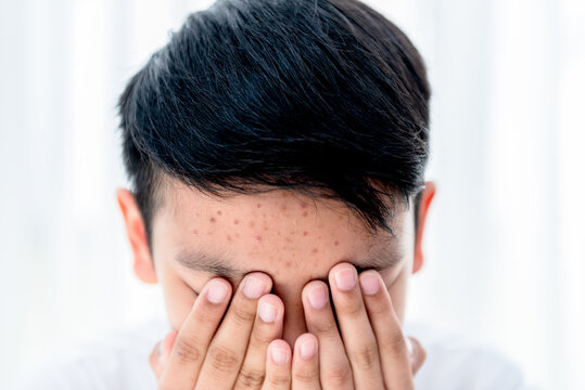 Asian teenage boy, covering his face with both hands, because embarrassed by acne and acne scars on forehead, with white background, to acne and skin care concept.