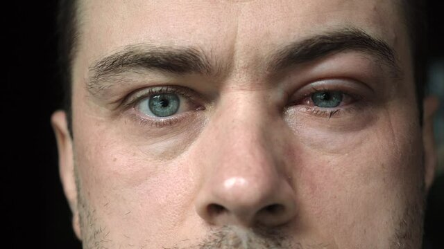 Close Up of Man with Severe Bloodshot Red Blood Eye Affected by Conjunctivitis or Insect Bite. Male Looking at Camera with Viral Blepharitis, Conjunctivitis. Irritated, Infected Eye or After Allergy