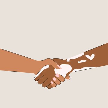 Hands of a man with vitiligo skin disease. Support, love and help. World vitiligo day. Flat vector illustration isolated