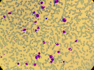 Leuco-erythroblastic anaemia and Chronic myelomonocytic leukemia (CMML), MPD, Blood smear under 100x microscopic  view