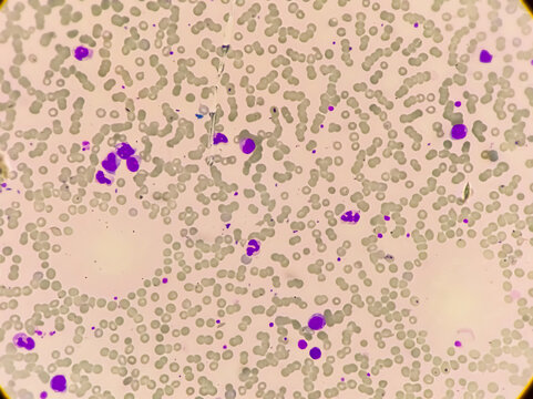Leuco-erythroblastic anaemia and Chronic myelomonocytic leukemia (CMML), MPD, Blood smear under 100x microscopic  view