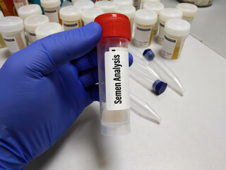 Semen analysis, sperm analysis doctor hold a container with semen sample for microscopic...