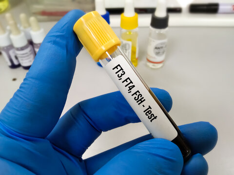 Blood sample in test tube for hormonal examination of thyroid gland in laboratory. FT3, FT4, FSH. Diagnosis of hyperthyroidism or hypothyroidism of a patient