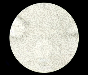 Acute thrombocytopenia and leucocytopenia. Close up Micrograph of dengue virus fever patient at...