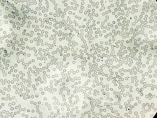 Acute thrombocytopenia and leucocytopenia. Close up Micrograph of dengue virus fever patient at...