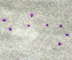 Blood film or smear leishman stained Microscopic show Leuco-erythroblastic anemia with...
