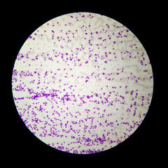 Blood smear leishman stained Microscopic 100x objective image of Acute mylohyoid leukemia (AML)....