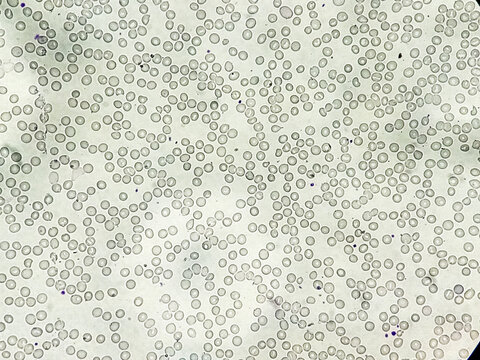 Acute thrombocytopenia and leucocytopenia. Close up Micrograph of dengue virus fever patient at medical laboratory.
