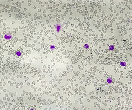Blood film or smear leishman stained Microscopic show Leuco-erythroblastic anemia with thrombocytopenia at medical laboratory.