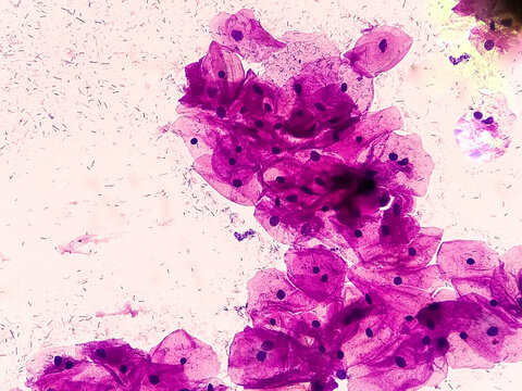 Microscopic view of normal human cervix cells. Squamous epithelium cells. Pap smear.