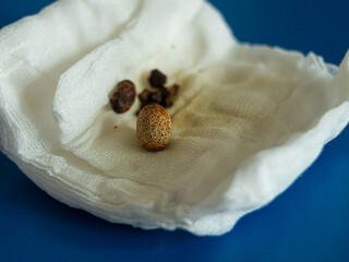 Removed gallstones on compress after gallbladder laparoscopic surgery endoscopy removing. Cholecystectomy on abdomen Liver dysfunction icteruswith bilirubin biliary tract obstruction precipitated bile