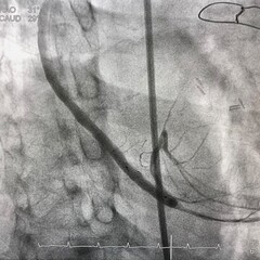 coronary angiogram showed saphenous vein graft (SVG) after Drug Eluting stent (DES) was deployed during percutaneous coronary intervention (PCI). - obrazy, fototapety, plakaty