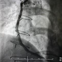 coronary angiogram showed saphenous vein graft (SVG) after Drug Eluting stent (DES) was deployed during percutaneous coronary intervention (PCI).