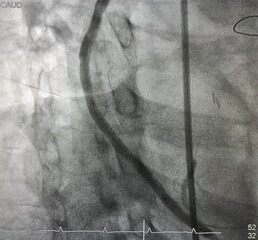 coronary angiogram showed saphenous vein graft (SVG) after Drug Eluting stent (DES) was deployed...