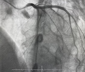 Normal left coronary artery (LCA) angiography.