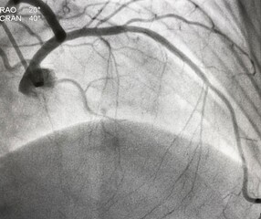 Normal left coronary artery (LCA) angiography.