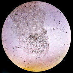 Microscopic view of dermatophytes, skin scraping for fungus test