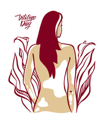 The figure of a girl with vitiligo disease. A concept on the topic of vitiligo disease. World Vitiligo Day. Vector illustration.