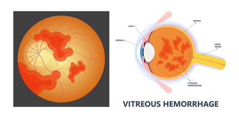 Eye floaters fluid vision retina myopia trauma surgery loss of light tear torn laser surgical repair older Detached blurry shadow Pain injury hole macular Age treat blood dark lose wear Pars Plana