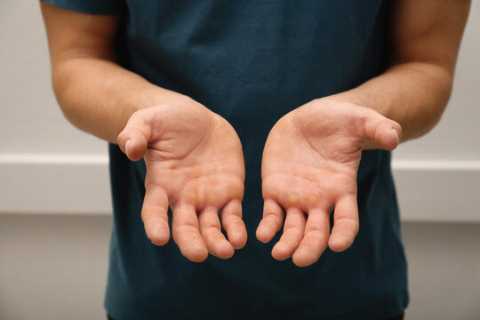 Man suffering from calluses on hands indoors, closeup