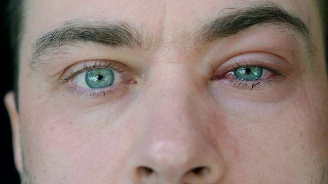Close Up of Man with One Swollen Infected Eye with Symptom of Conjunctivitis or After Allergy, Insect Bite. Male with Inflamed Tearful Eye Looking in Camera. Allergies, Stroke, or Virus Eye Disease
