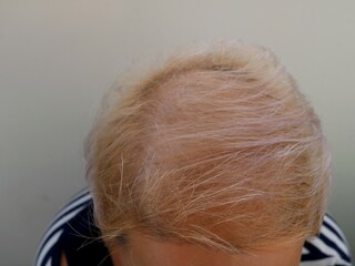 close-up of a balding white woman's head, thinning dyed blonde hair on a woman's head, top view of the skin shining through the rare hair of an unrecognizable woman, hair loss problem in women