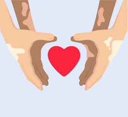  Vitiligo. Hands with vitiligo depigmantation forming a heart shape symbol.