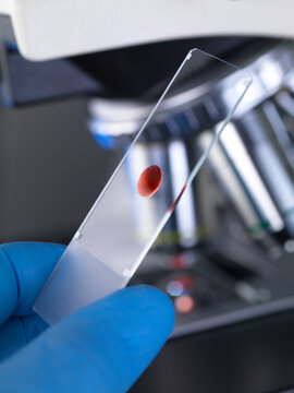Scientist examining a glass slide containing a human sample under a microscope
